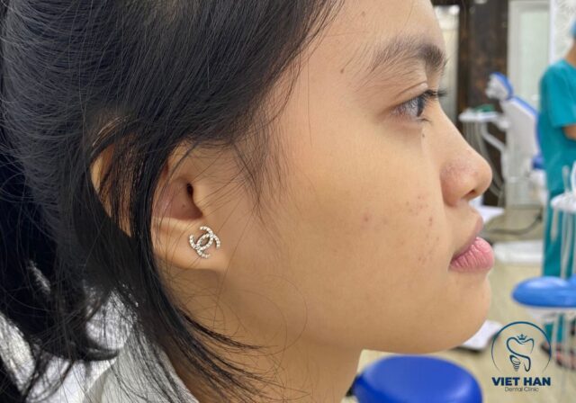 Khớp cắn ngược gây khó ăn nhai, mất thẩm mỹ và tăng nguy cơ bệnh răng miệng.