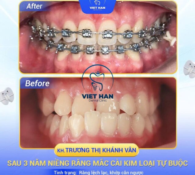 Cải thiện khớp cắn ngược tại Nha khoa Việt Hàn an toàn, hiệu quả, thẩm mỹ cao.
