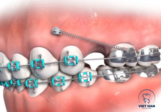 Cấu tạo minivis trong chỉnh nha và sự khác biệt với răng sữa ở từng giai đoạn phát triển.