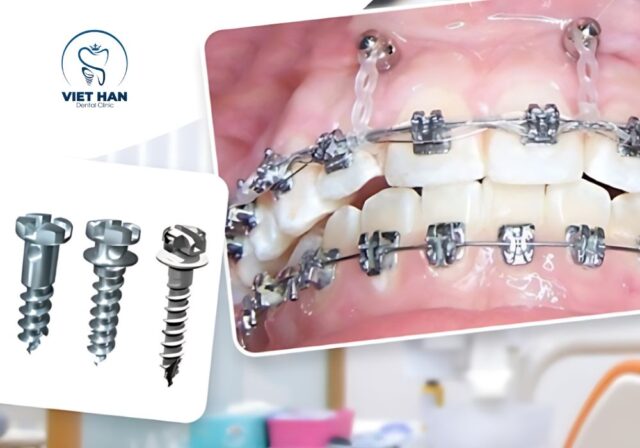 Minivis hỗ trợ kéo răng chính xác, khác với chức năng giữ chỗ tự nhiên của răng sữa ở trẻ nhỏ.