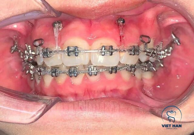 Hình ảnh mô phỏng quá trình cắm minivis an toàn, khác biệt với thay đổi sinh lý của răng sữa.