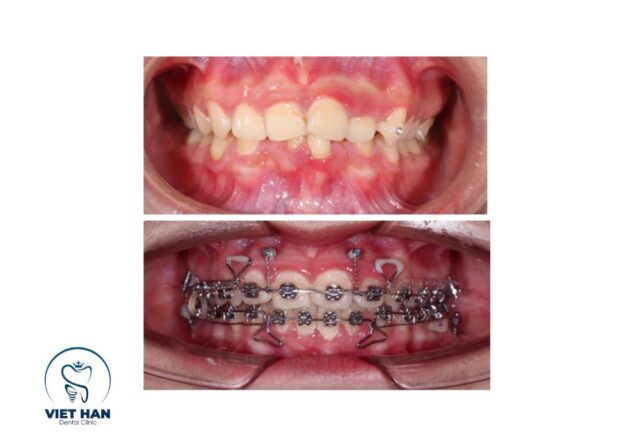 Chăm sóc sau cắm minivis giúp hồi phục nhanh, tương tự việc bảo vệ răng sữa để tránh biến chứng.