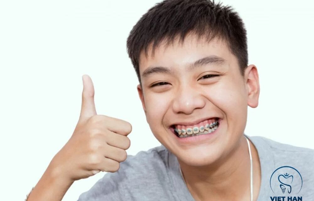 Niềng răng trẻ em sớm tốt không? Lợi ích phụ huynh nên biết
