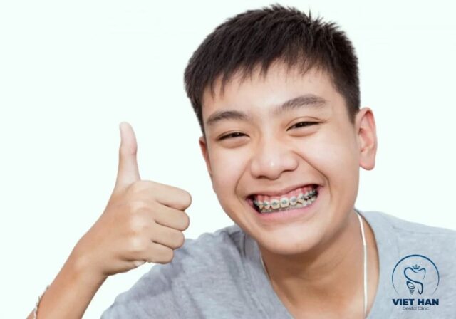 Can thiệp sớm bằng niềng răng trẻ em giúp răng dịch chuyển dễ hơn