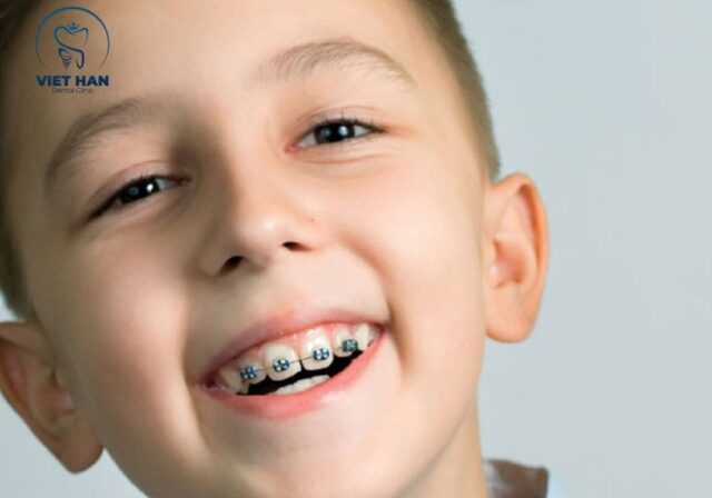 Lợi ích của niềng răng trẻ em là cải thiện ăn nhai và thẩm mỹ rõ rệt