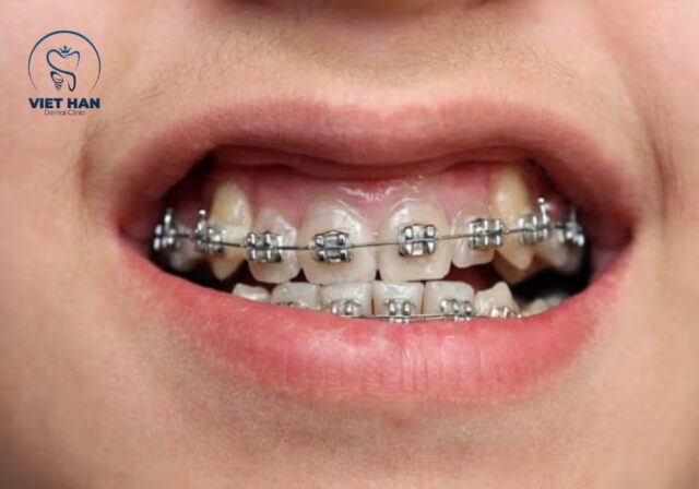 Độ tuổi vàng để niềng răng trẻ em giúp đạt hiệu quả chỉnh nha tối ưu