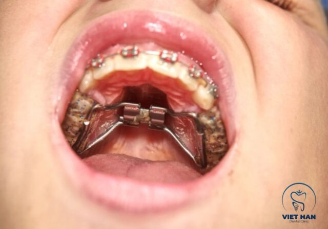 Khí cụ nong hàm giúp mở rộng cung hàm, hỗ trợ niềng răng hiệu quả.