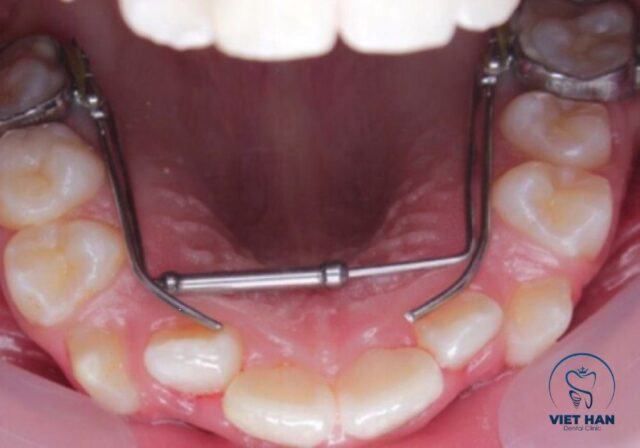 Nong hàm được chỉ định khi cung hàm hẹp hoặc răng thiếu chỗ sắp xếp.