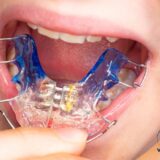 Nong hàm giúp khuôn mặt cân đối hơn nhưng thay đổi nhẹ, khó nhận biết.