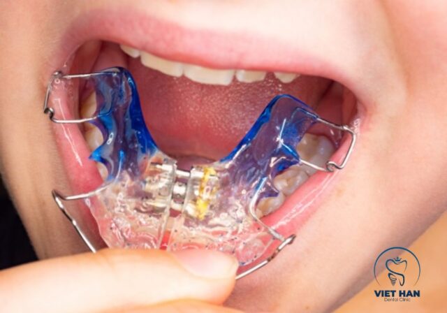 Nong hàm giúp khuôn mặt cân đối hơn nhưng thay đổi nhẹ, khó nhận biết.