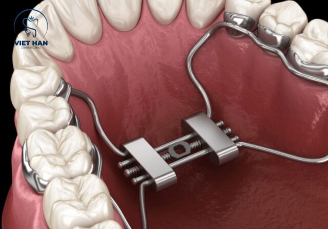 Nong hàm thường kéo dài 1–3 tháng tùy phương pháp và tình trạng răng.