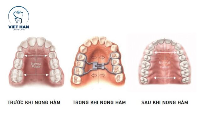 Nong hàm giúp cải thiện khớp cắn và tăng hiệu quả niềng răng.