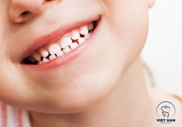 Hình ảnh minh họa cấu tạo và vị trí răng sữa trong hàm trẻ nhỏ.