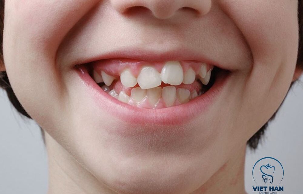 Hiểu đúng về răng sữa ba mẹ cần biết để không hối hận