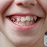 Mất răng sữa sớm có thể gây lệch răng và sai khớp cắn ở trẻ.