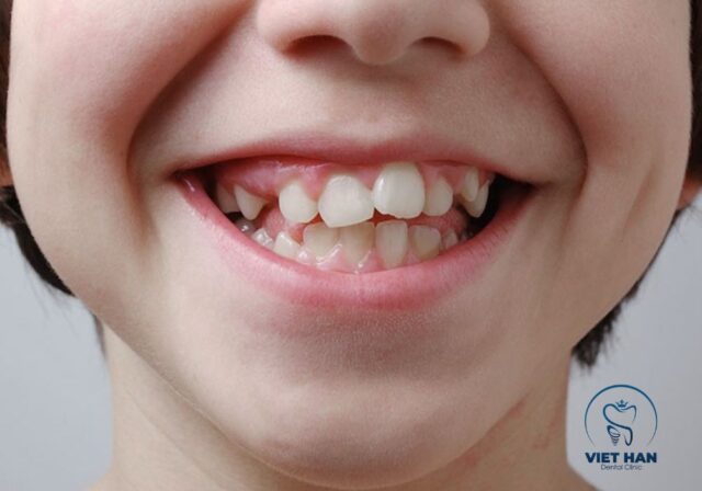 Mất răng sữa sớm có thể gây lệch răng và sai khớp cắn ở trẻ.