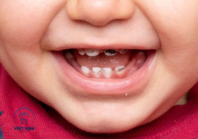 Hướng dẫn vệ sinh răng sữa đúng cách giúp phòng ngừa sâu răng hiệu quả.