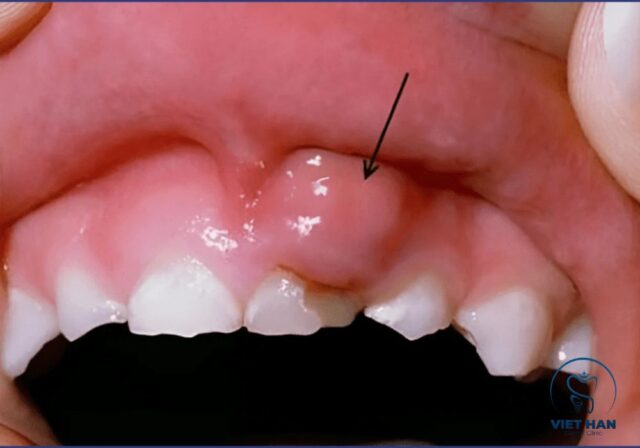 Sưng nướu răng khiến nướu đỏ, đau và dễ chảy máu.