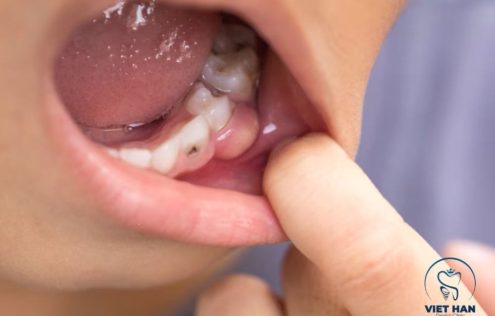Sưng nướu răng: Dấu hiệu, nguyên nhân và cách xử lý hiệu quả