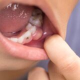 Triệu chứng sưng nướu răng gồm đau, chảy máu và hôi miệng