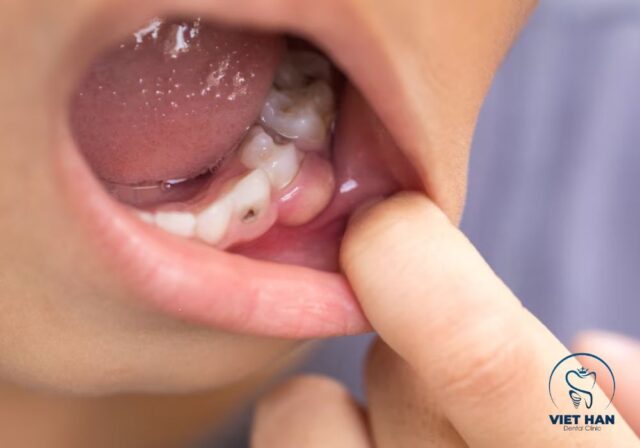 Triệu chứng sưng nướu răng gồm đau, chảy máu và hôi miệng