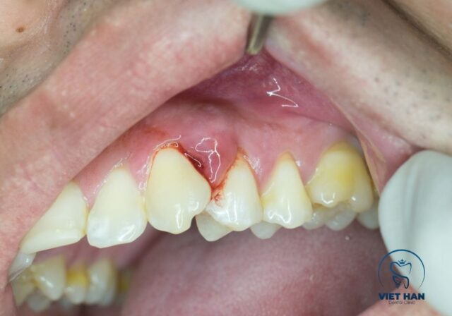 Nguyên nhân sưng nướu răng thường do mảng bám và vi khuẩn.