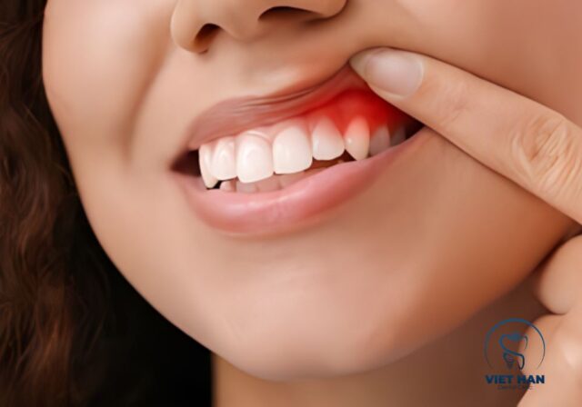 Sưng nướu răng kéo dài có thể gây mất răng và biến chứng.