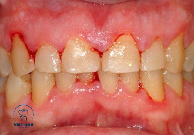 Điều trị sưng nướu răng cần làm sạch mảng bám và chăm sóc đúng cách.