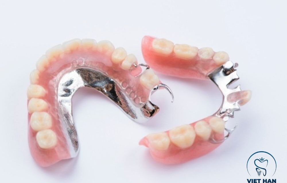 Có nên trồng răng tháo lắp không? Giải đáp A–Z