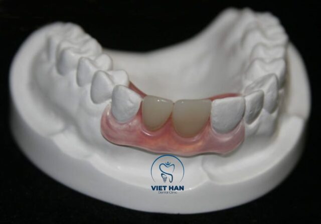 Sau khi trồng răng tháo lắp, người dùng cần vệ sinh mỗi ngày để tránh vi khuẩn tích tụ