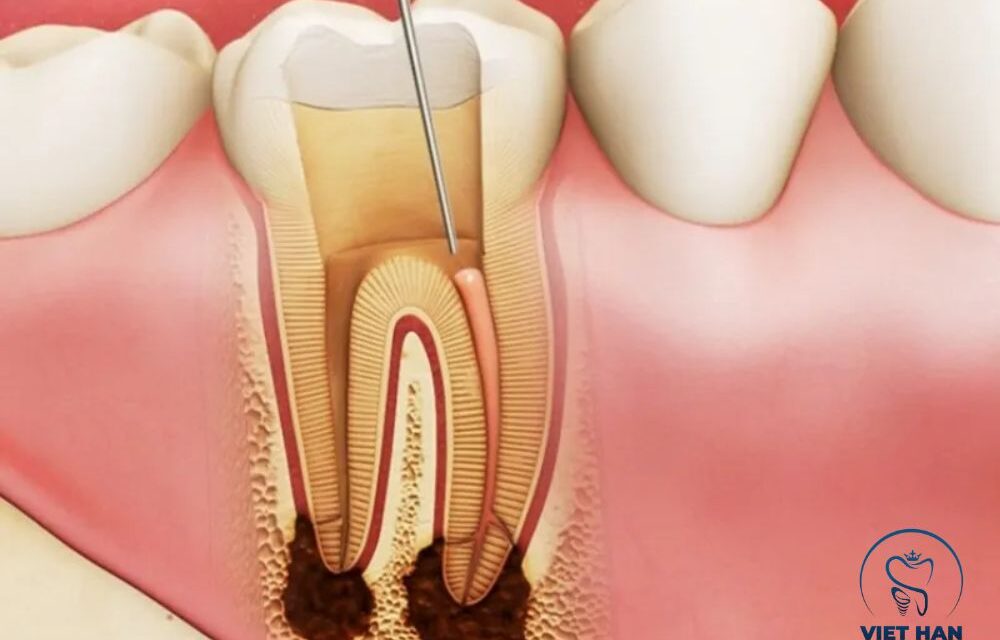 Viêm tủy răng: Nhận biết dấu hiệu sớm để tránh mất răng