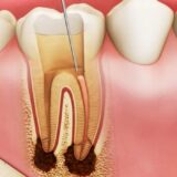 Viêm tủy răng là tình trạng viêm nhiễm bên trong răng do vi khuẩn xâm nhập vào tủy.