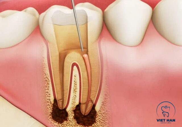 Viêm tủy răng là tình trạng viêm nhiễm bên trong răng do vi khuẩn xâm nhập vào tủy.