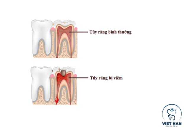 Dấu hiệu viêm tủy răng thường gặp là đau nhức, ê buốt khi ăn nóng lạnh hoặc về đêm.