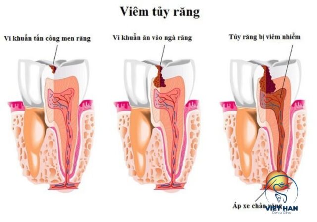 Nguyên nhân viêm tủy răng chủ yếu do sâu răng, nứt vỡ răng hoặc vi khuẩn xâm nhập.