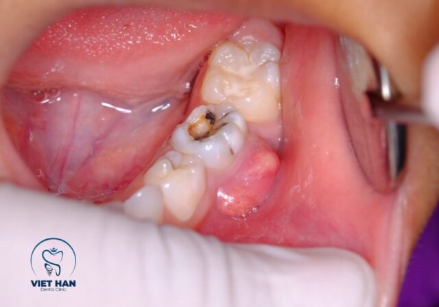 Viêm tủy răng cần điều trị sớm khi xuất hiện đau kéo dài, ê buốt hoặc nhạy cảm bất thường.