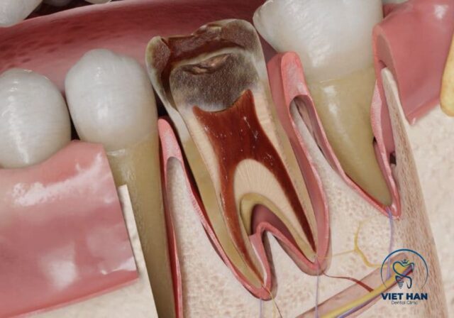 Viêm tủy răng không thể tự khỏi, các biện pháp tại nhà chỉ giúp giảm đau tạm thời.
