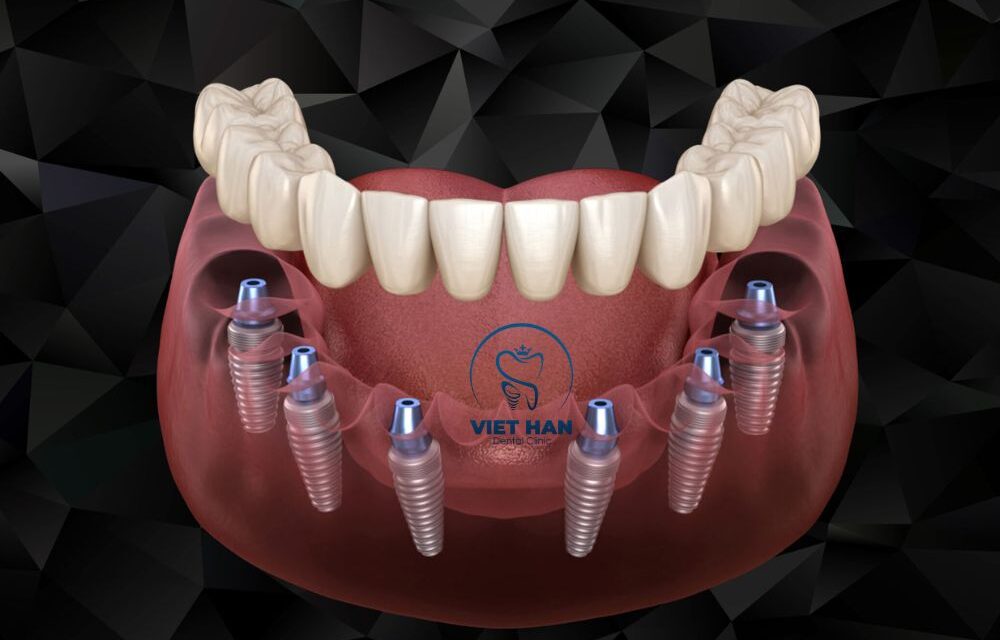 Cấy Implant là gì? Tìm hiểu chi tiết trước khi thực hiện