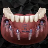 Cấy Implant giúp phục hồi răng mất với khả năng ăn nhai gần như răng thật.