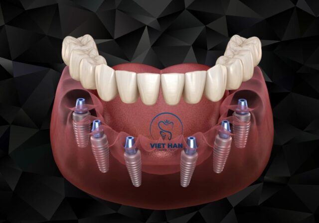 Cấy Implant giúp phục hồi răng mất với khả năng ăn nhai gần như răng thật.