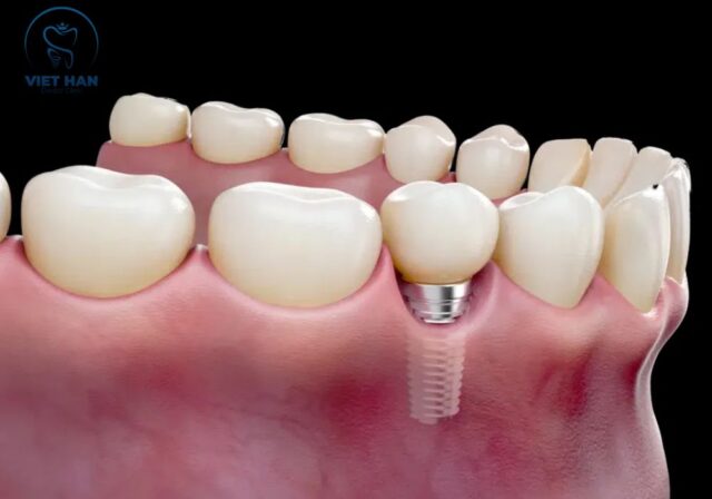 Người mất răng lâu năm có thể được chỉ định cấy Implant để phục hồi chức năng nhai.