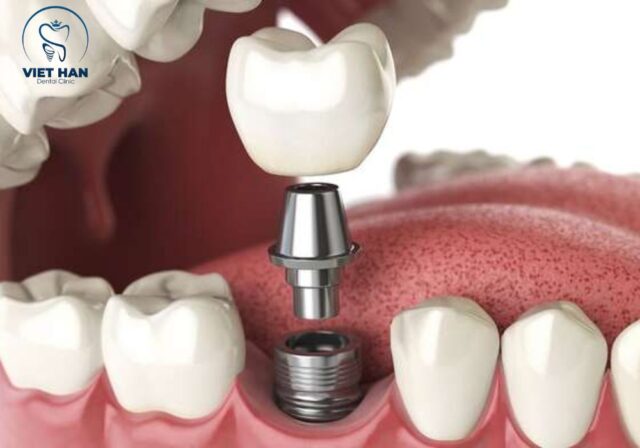 Cấy Implant giúp cải thiện thẩm mỹ và hạn chế tiêu xương hàm hiệu quả.