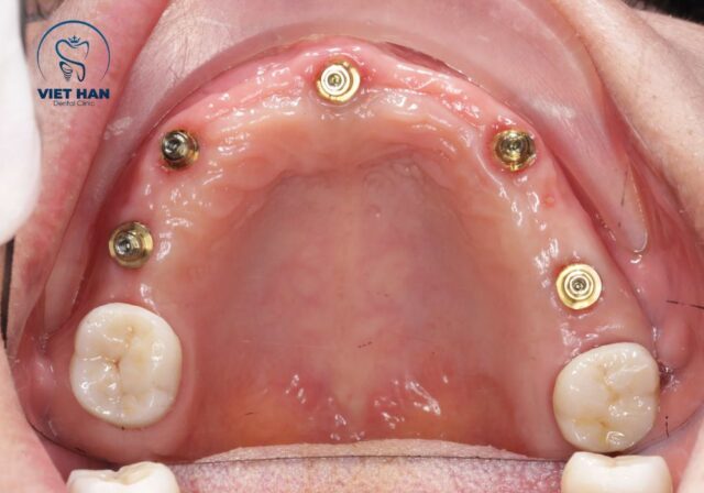 Quy trình cấy Implant cần được thực hiện đúng kỹ thuật để đảm bảo độ ổn định.