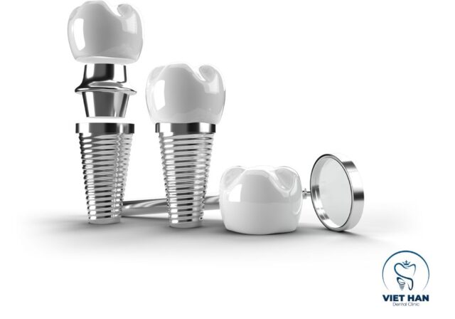 Chăm sóc đúng cách sau cấy Implant giúp tăng độ bền và ổn định của trụ răng.
