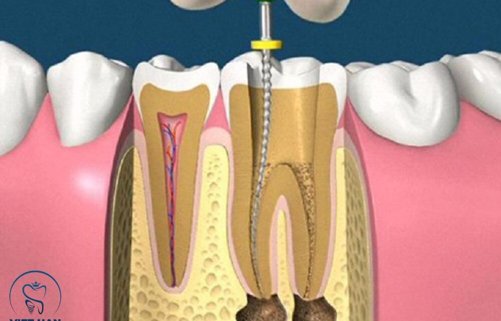 Chữa tủy răng và những điều cần biết để tránh mất răng