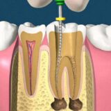 Chữa tủy răng giúp loại bỏ viêm nhiễm và bảo tồn răng thật hiệu quả.