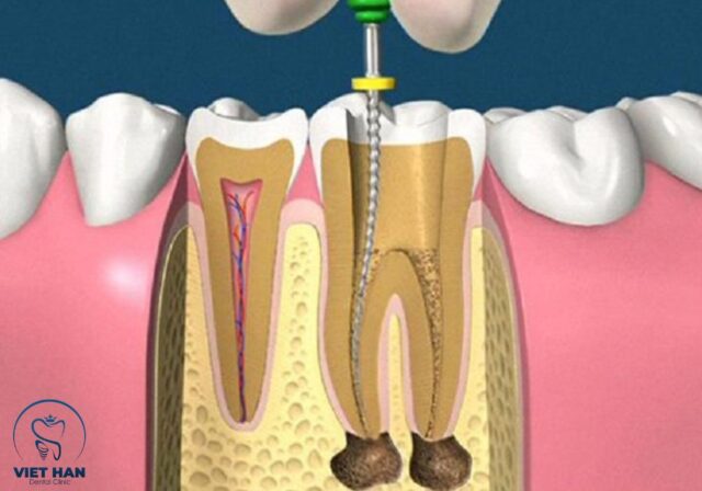 Chữa tủy răng giúp loại bỏ viêm nhiễm và bảo tồn răng thật hiệu quả.
