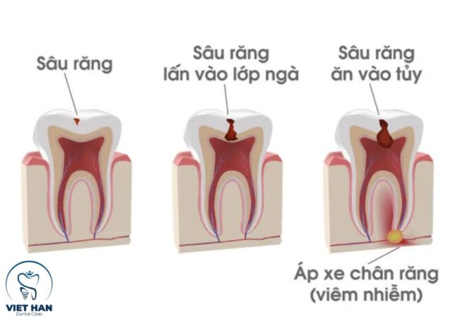 Hình ảnh mô phỏng cấu trúc bên trong khi chữa tủy răng.