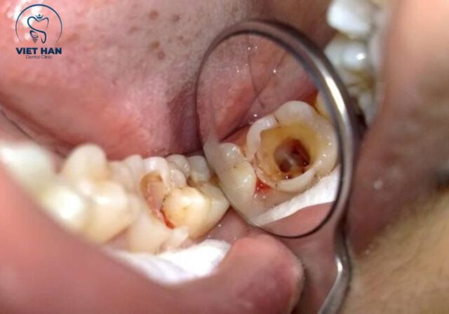 Chữa tủy răng giúp giảm đau nhức và ngăn nhiễm trùng lan rộng.