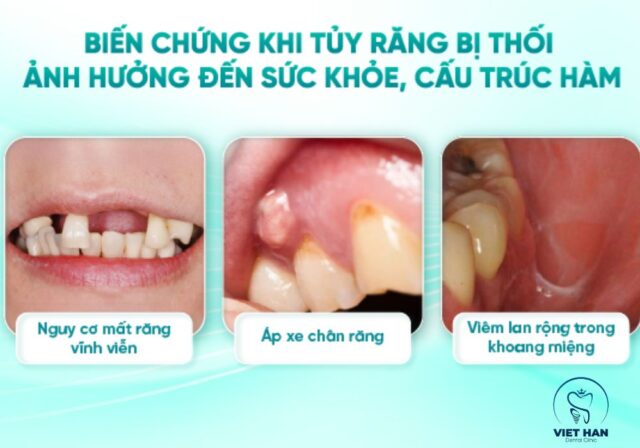 Biến chứng nguy hiểm nếu không chữa tủy răng kịp thời.